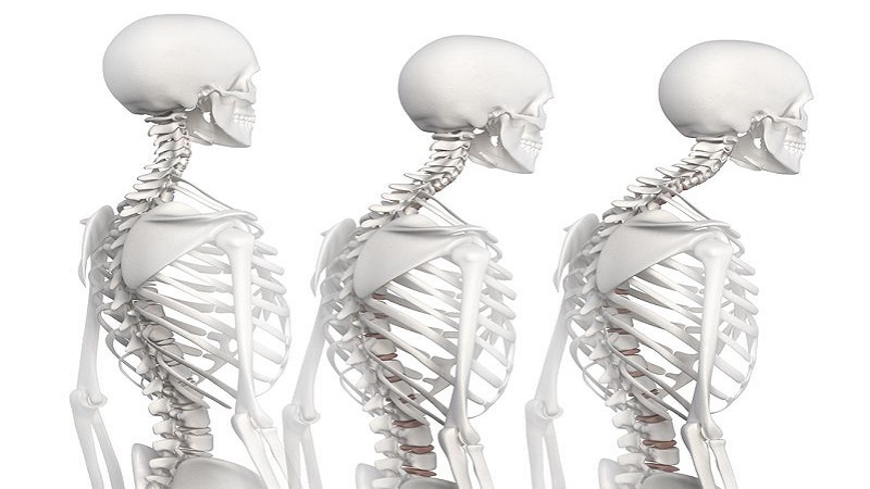 طب فیزیکی و توانبخشی اصفهان ناهنجاری گردنی رو به جلو