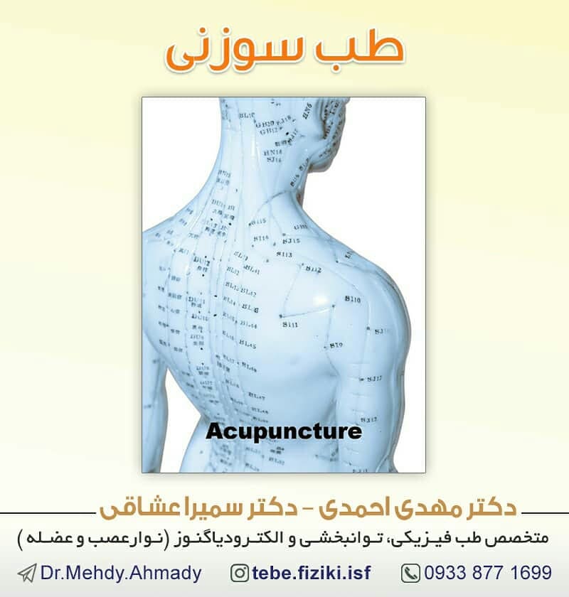 طب سوزنی يا آکوپانکچر