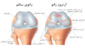 متخصص طب فیزیکی و توانبخشی اصفهان | آرتروز زانو چیست
