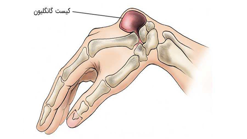 متخصص طب فیزیکی و توانبخشی اصفهان | علائم کیست مچ دست