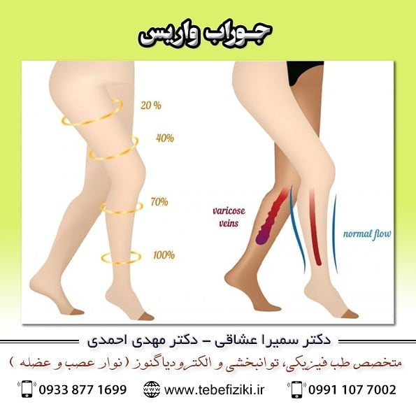 جوراب واریس راه‌حل مؤثر درمان واریس | متخصص طب فیزیکی و توانبخشی اصفهان
