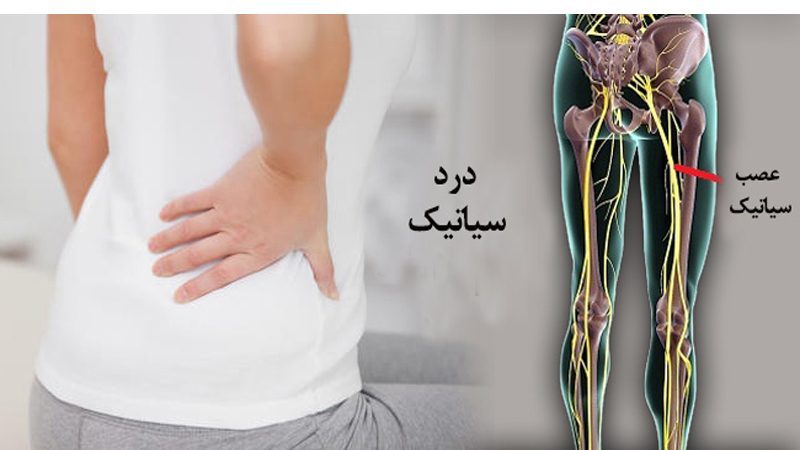 درمان قطعی سیاتیک و ورزشهای مفید | متخصص طب فیزیکی و توانبخشی اصفهان