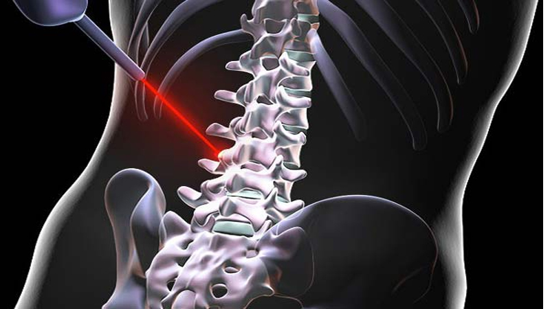 اثر لیزر تراپی بر دردهای سیاتیک | متخصص طب فیزیکی و توانبخشی اصفهان