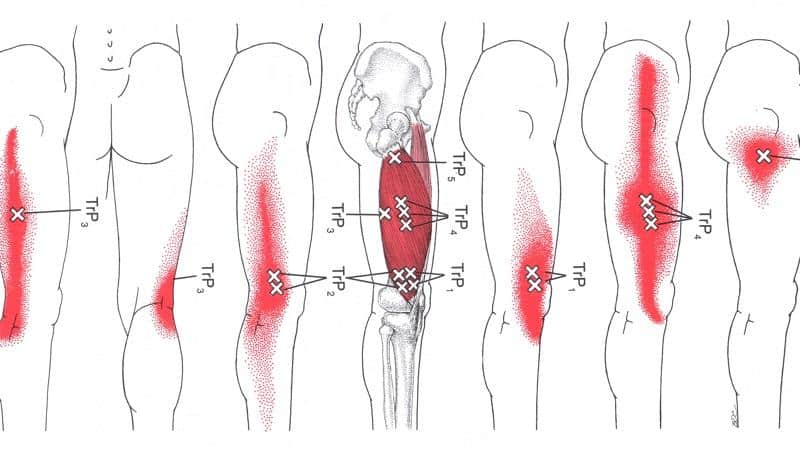 علل ایجاد نقاط ماشه ای یا تریگر پوینت | متخصص طب فیزیکی و توانبخشی اصفهان