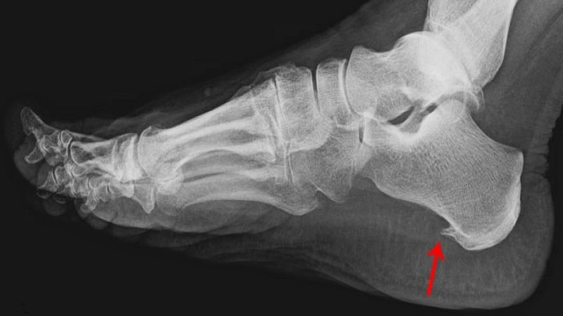 بررسی التهاب فاشیای کف پا یا خار پاشنه | متخصص طب فیزیکی و توانبخشی اصفهان