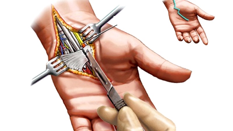 مراقبت های بعداز عمل جراحی سندرم تونل کارپ | متخصص طب فیزیکی و توانبخشی اصفهان