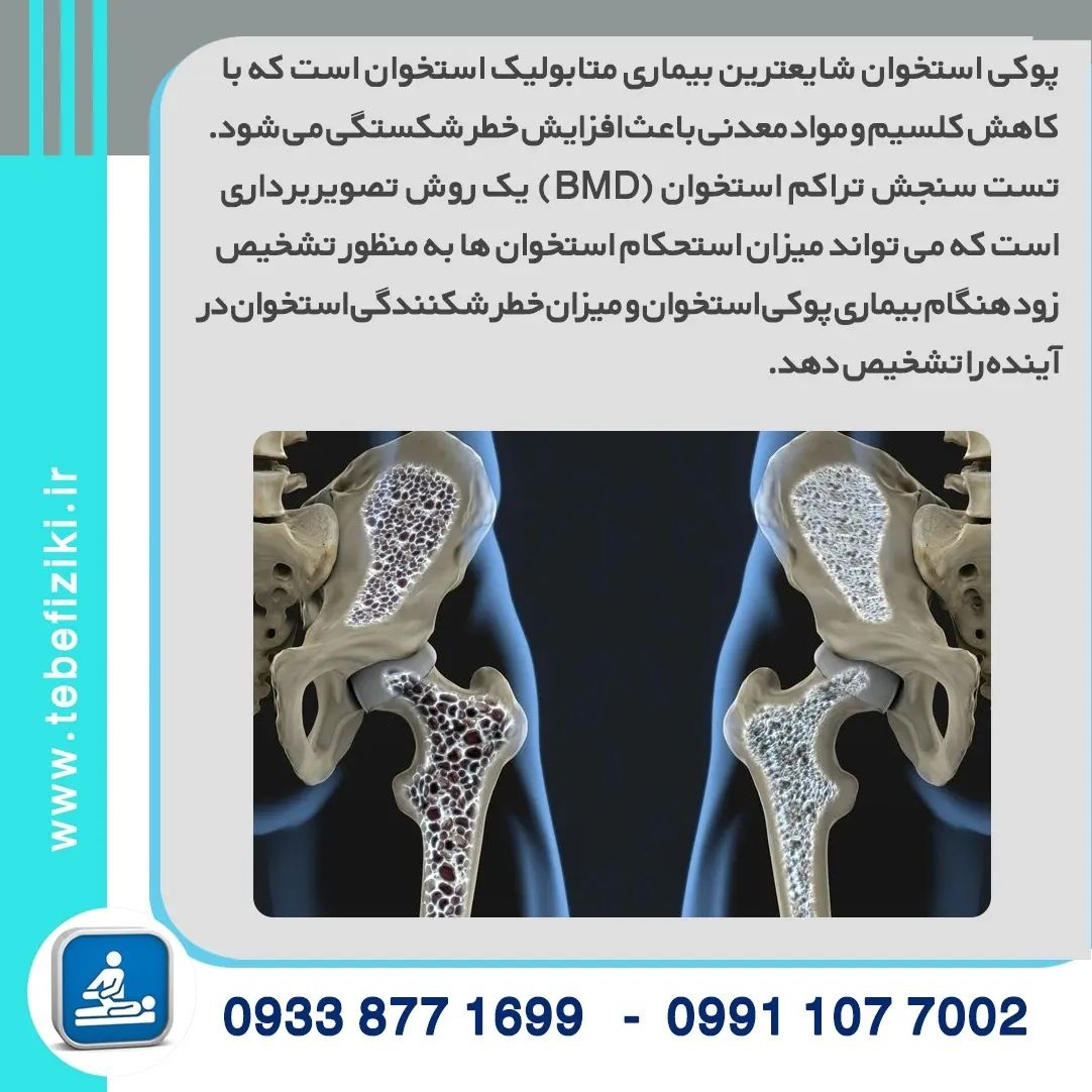 سنجش تراکم استخوان در چه کسانی لازم است؟ | متخصص طب فیزیکی و توانبخشی اصفهان
