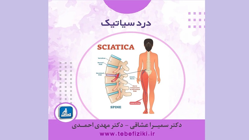بررسی علائم درد سیاتیک | متخصص طب فیزیکی و توانبخشی اصفهان