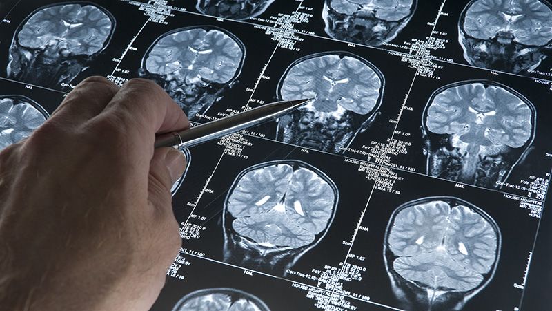 علت و عوارض انواع بیماری ام اس چیست؟ | متخصص طب فیزیکی و توانبخشی اصفهان