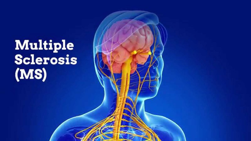 علت و عوارض انواع بیماری ام اس چیست؟ | متخصص طب فیزیکی و توانبخشی اصفهان