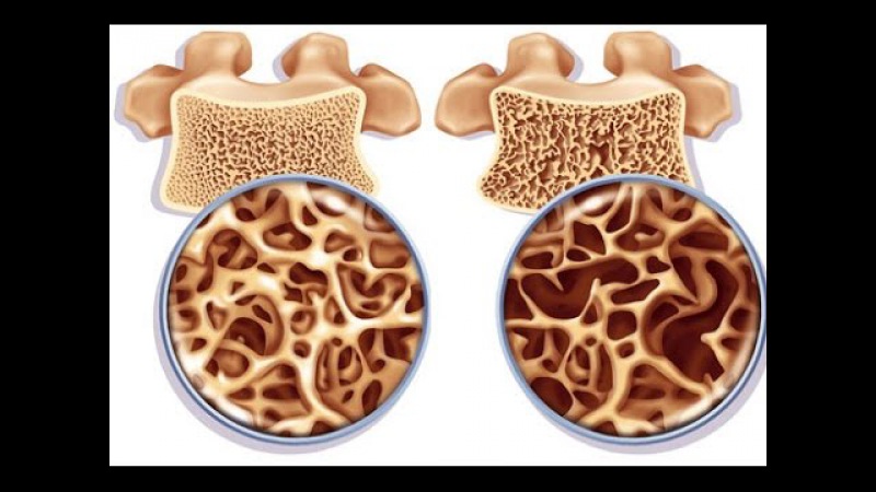 عوامل خطرزا و عوارض پوکی استخوان | متخصص طب فیزیکی و توانبخشی اصفهان