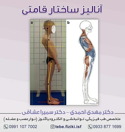 آنالیز ساختار قامتی | متخصص طب فیزیکی و توانبخشی اصفهان
