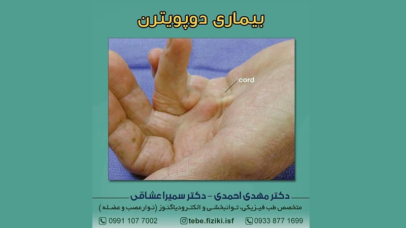 بیماری دوپویترن | متخصص طب فیزیکی و توانبخشی اصفهان