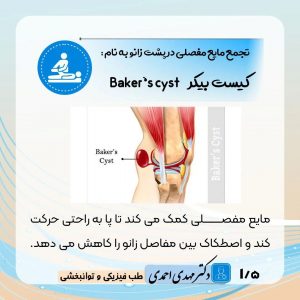 کیست بیکر (Baker’s cyst) چیست؟ | متخصص طب فیزیکی و توانبخشی اصفهان
