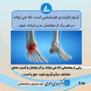 آرتروز مچ پا چیست؟ | متخصص طب فیزیکی و توانبخشی اصفهان
