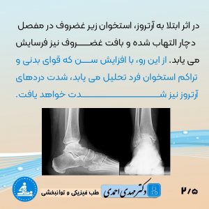 آرتروز مچ پا چیست؟ | متخصص طب فیزیکی و توانبخشی اصفهان