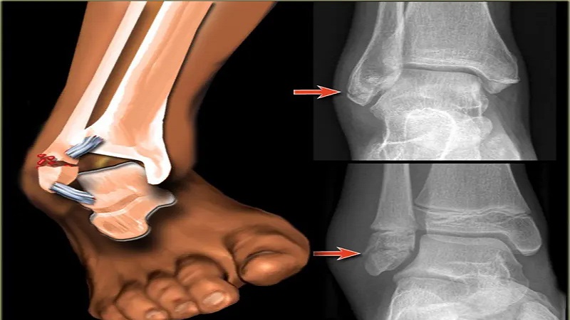 ورزش و حرکات درمانی برای شکستگی مچ پا|متخصص طب فیزیکی و توانبخشی اصفهان