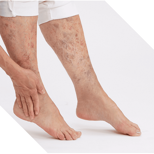 زخم استاز وریدی چیست؟ | متخصص طب فیزیکی و توانبخشی اصفهان