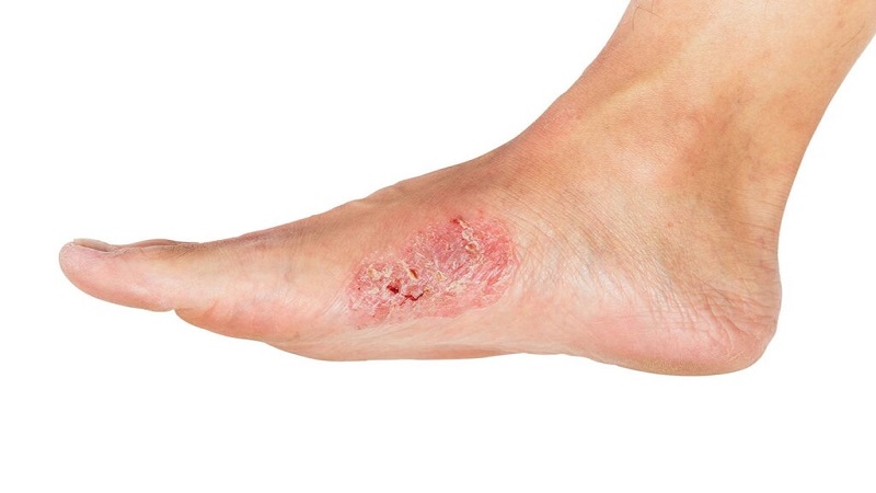 عوامل خطر برای ایجاد زخم استاز وریدی | متخصص طب فیزیکی و توانبخشی اصفهان
