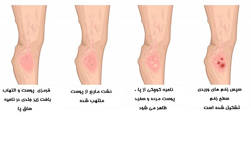 علائم زخم استاز وریدی چیست؟ | متخصص طب فیزیکی و توانبخشی اصفهان