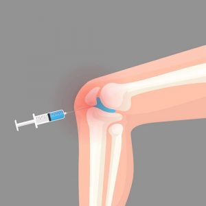 آیا تزریق ژل برای آرتروز پیشرفته موثر است؟ | متخصص طب فیزیکی و توانبخشی اصفهان