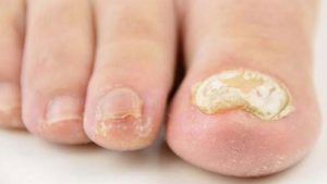 انواع قارچی که باعث عفونت ناخن پا میشوند، کدامند؟ | متخصص طب فیزیکی و توانبخشی اصفهان